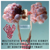 Multicystic Dysplastic Kidney With Ipsilateral Abnormalities Of Genitourinary Tract