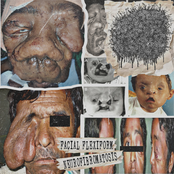 Facial Flexiform Neurofibromatosis