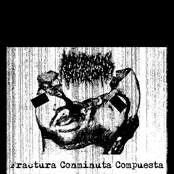 Fractura Conminuta Compuesta