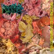 The Gross Appeareance For Multicystic Renal Dysplasia