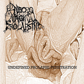 Undefined Prolapse Penetration