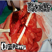 Urachus / Cuntpump split