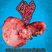 Cystic Lesion in Gangrenous Fallopian Tube