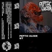 Peptic Ulcer
