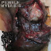 Penile Myiasis / Severe Penile Fracture