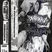 Anal Birth / Dermatofibrosarcoma