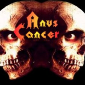 Anus Cancer