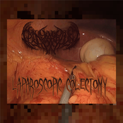 Laparoscopic Colectomy