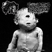 Holoprosencephaly Fetus with Cyclocephaly