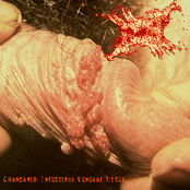 Chancroid: Infectious Veneral Ulcer
