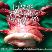 Total Abdominal Hysterectomy With Bilateral Salpingo-Cophorectomy