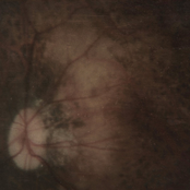 Bereft of Xerotic Layers