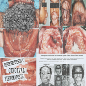 Hereditery Gingival Fibromatosis