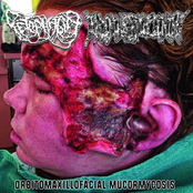 Orbitomaxillofacial Mucormycosis