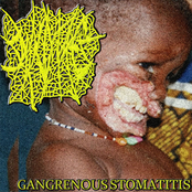 GANGRENOUS STOMATITIS