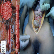 Melanocytic Tumors Of Uncertain Malignant Potential / Melted / Wrong Illegal Abortion Procedure With Alarming Consequences / Herophilus