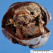 SPLIT WITH HYPEREMESIS