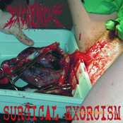 Surgical exorcism