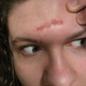 Third Eye Opening Scar