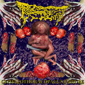 Cephalothoracopagus Failure