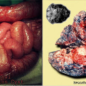 Duodenal Duplication Cyst