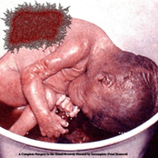 A Complete Surgery to the Hand Severely Burned by Incomplete Fetal Removal