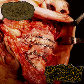 Carnal Agony Suffering From Osteomyelitis In The Coccyx