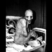 Lesch-Nyhan Syndrome