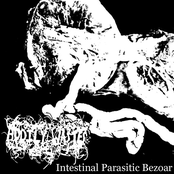 Intestinal Parasitic Bezoar