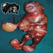 Neu-Laxova Syndrome