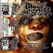 FIBRINOPURULENT CASE OF BLOAT CAUSING PURULENT DRAINAGE