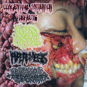 4-Way Hemangiopericytoma Split