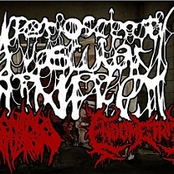 Ateriosclerotic Vascular Infect