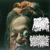 Botched Anastomosis J-Pouch / Gangrene Discharge