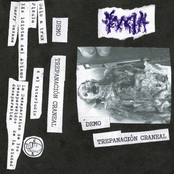 Trepanación Craneal (demo)