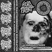 Various Stages Of Human Decomposition