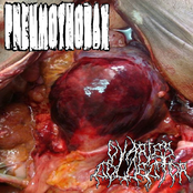 Pneumothorax / Ovaries Collector