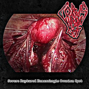 Severe Ruptured Hemorrhagic Ovarian Cyst