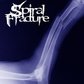Spiral Fracture: Spiral Fracture
