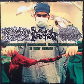 Paroxysmal Nocturnal Hemoglobinuria