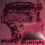 Cerebral Astrocytoma