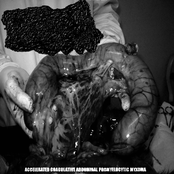 Accelerated Coagulative Abdominal Promyelocytic Myxoma