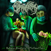 Radiation Abortion Of A Mutilated Fetus