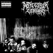 Abscessus Cerebri