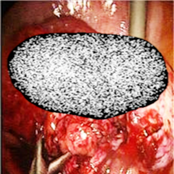 Splanchnopleuriticexenteration