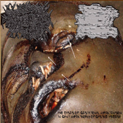 Two Cases Of Gestational Hypertension In Giant Hypertrophy Of Gastric Mucosa
