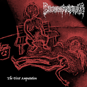 The First Amputation