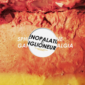 Sphenopalatine Ganglioneuralgia