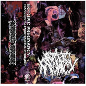 Ectopic Pregnancy: Transorbital Endotracheal Intubation