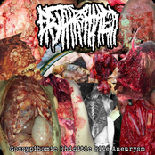 Gossypibomic Rhinitic Bile Aneurysm